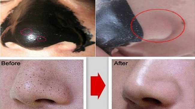 Gel lột mụn đầu đen được chế tạo một hỗn hợp keo đặc có tính bám da tốt 