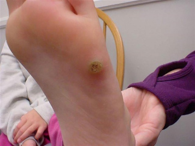 Mụn cóc ở lòng bàn chân là dạng nhiễm trùng da do virus HPV gây nên 