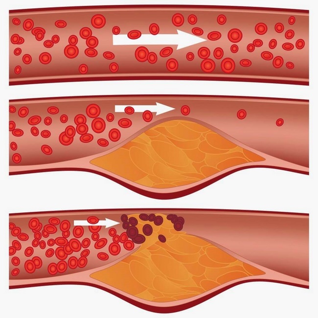 Cải thiện huyết áp và Cholesterol trong máu 