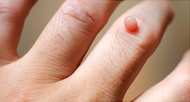 điều trị mụn cóc