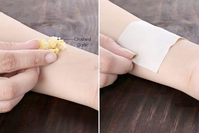 điều trị mụn cóc