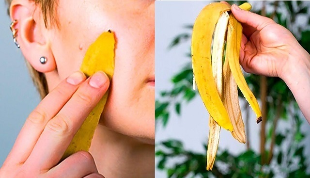 mặt nạ chuối trị mụn 
