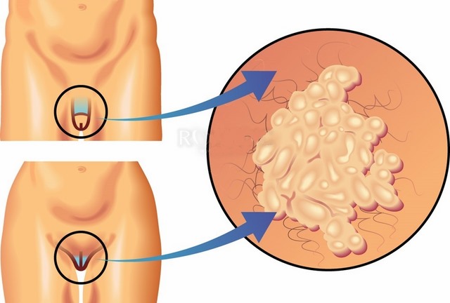 Mụn cóc sinh dục