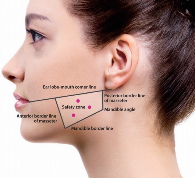 Tiêm Botox thon gọn mặt