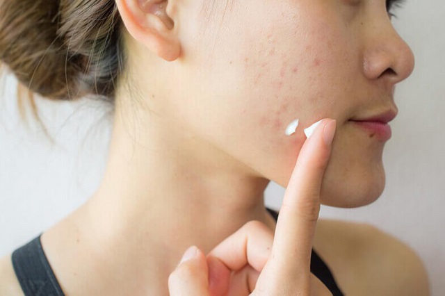 trị mụn bằng dầu dừa