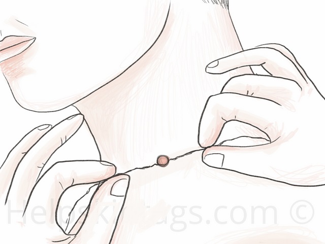 Mụn thịt thừa ở cổ