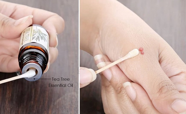 Mụn thịt thừa ở cổ