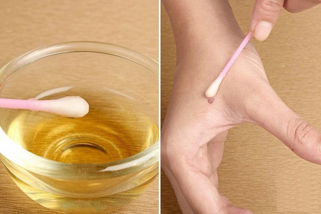 Mụn thịt thừa ở cổ