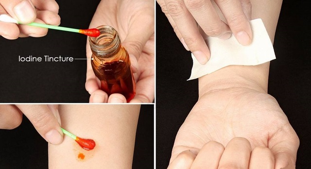 Mụn thịt thừa ở cổ
