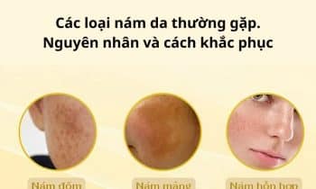 nguyên nhân và cách khắc phục các loại nám da