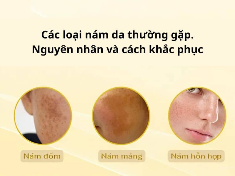 nguyên nhân và cách khắc phục các loại nám da