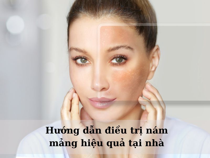 cách trị nám mảng tại nhà