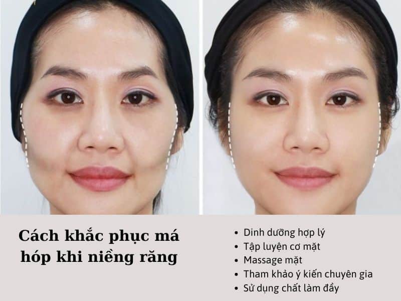 cách khắc phục tình trạng má hóp