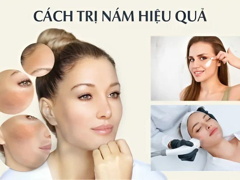 cách điều trị các loại nám da