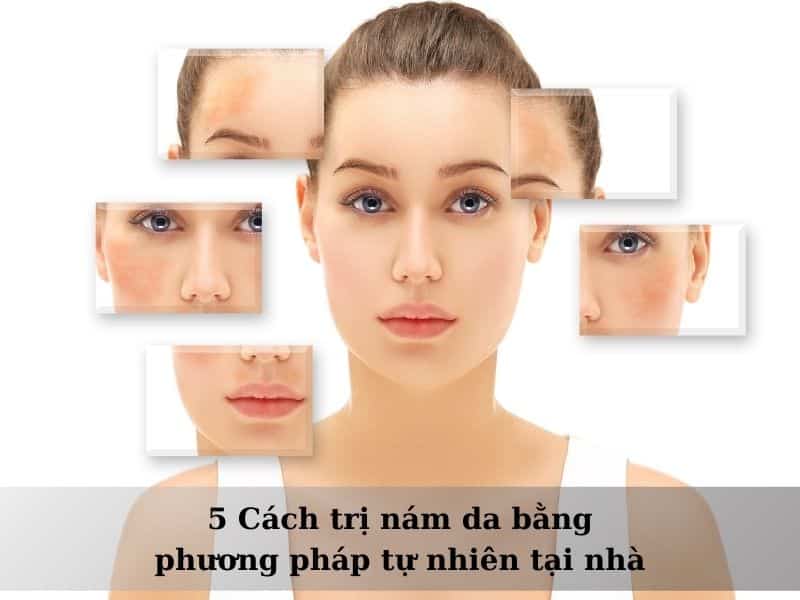 cách trị nám da bằng phương pháp tự nhiên