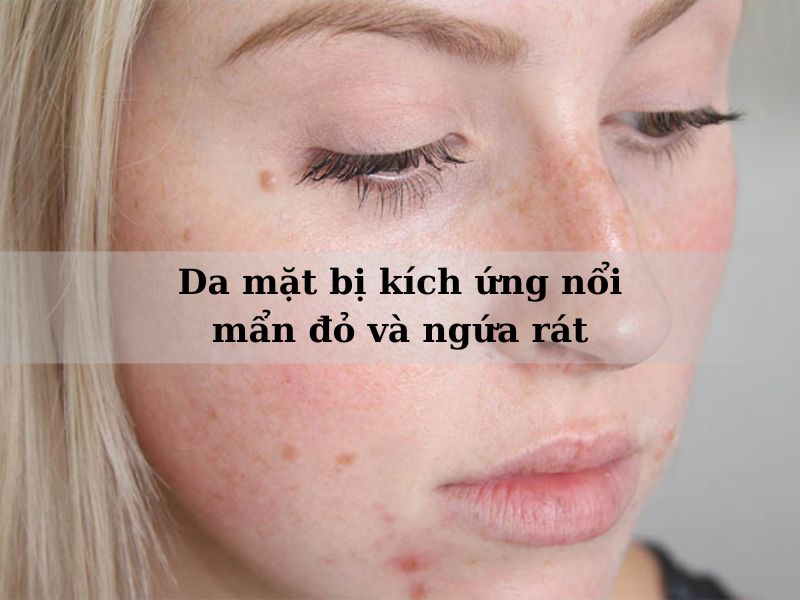 da mặt bị kích ứng nổi mẩn đỏ