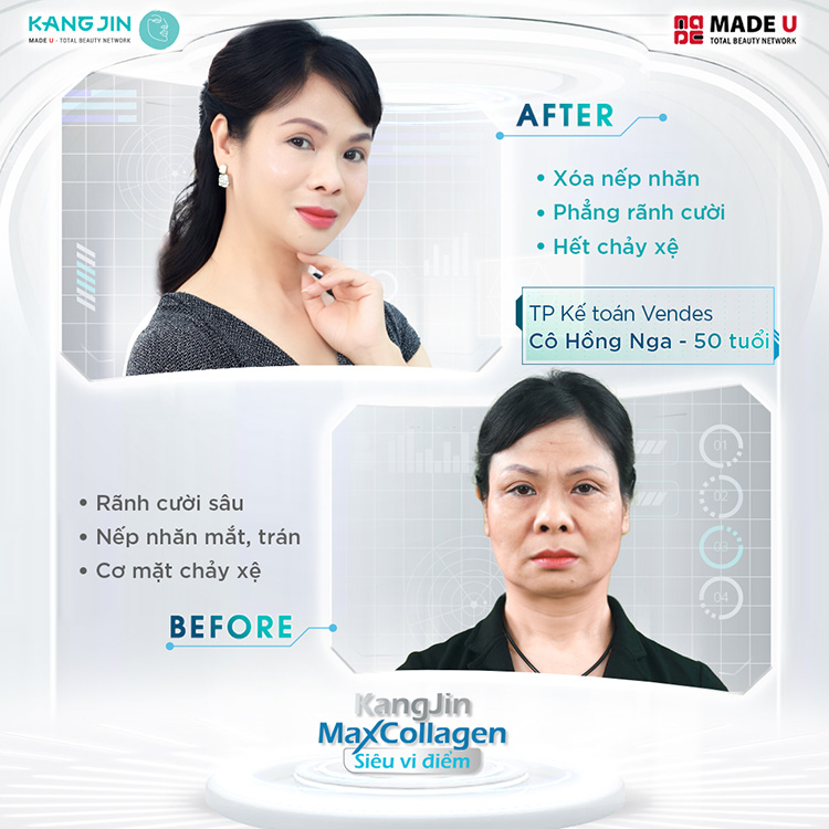 làm mờ rãnh cười bằng liệu pháp Maxcollagen Diamond Siêu Vi Điểm