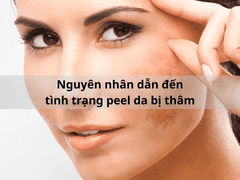 peel da bị thâm do nguyên nhân nào