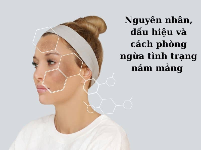 những nguyên nhân và dấu hiệu nhận biết nám mảng là gì