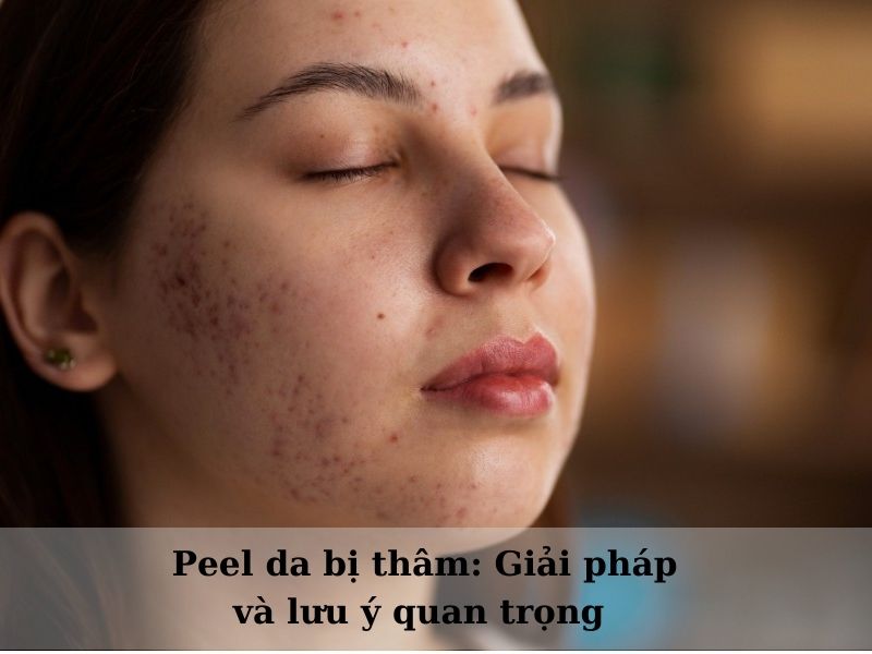 peel da bị thâm thì phải làm sao